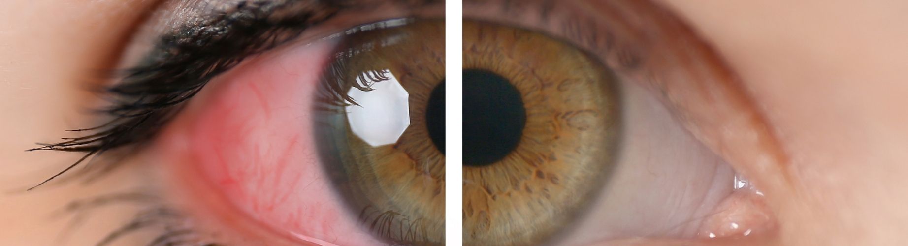 photo showing a red eye compared to a healthy eye