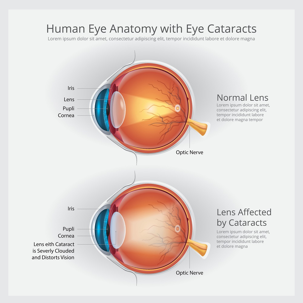 chart describing cataracts