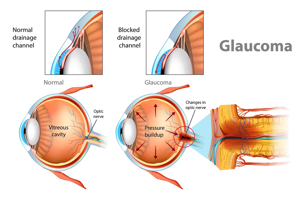 chart explaining glaucoma
